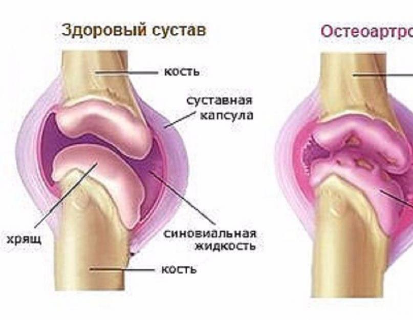 Остеоартроз что это такое как лечить. Остеоартроз синовиальная жидкость. Здоровый сустав колена.